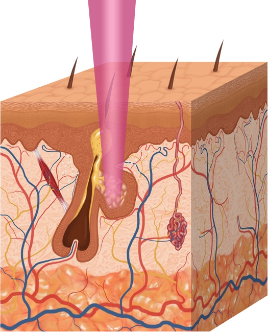 Laser treatment of acne