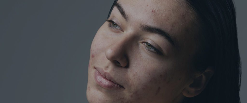 Acne Laser Treatment