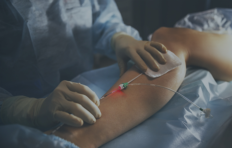 Endovenous Laser Ablation