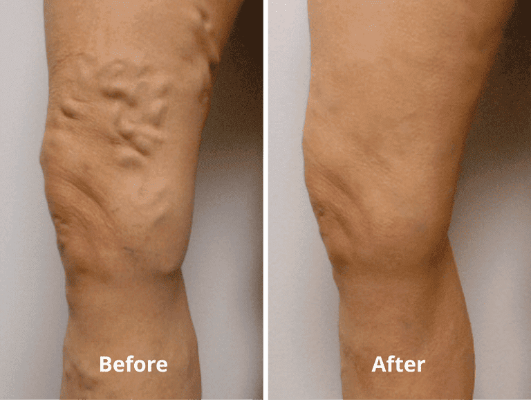 EVLT Before and After