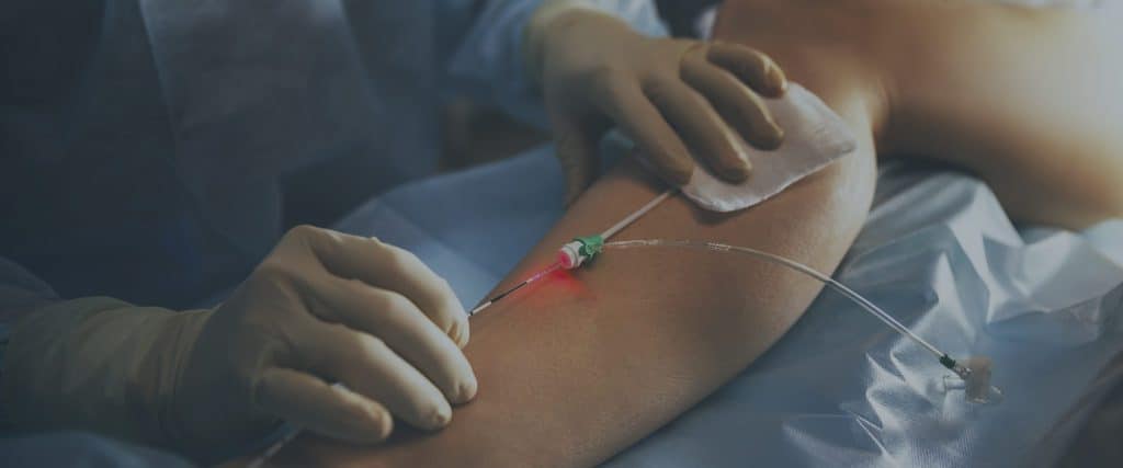 Endovenous Laser Ablation