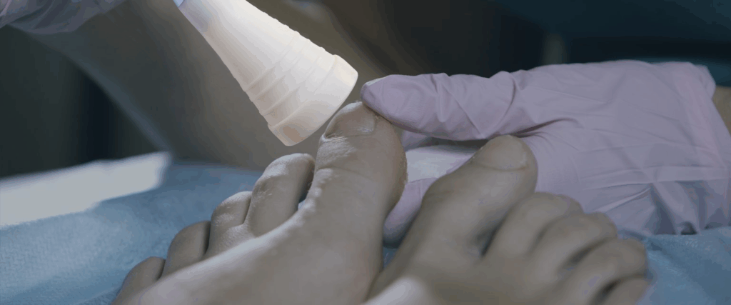Treating nail fungus with Eclipse-1064 laser system