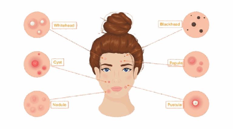 Acne laser therapy